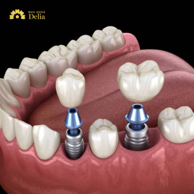 Implant placement surgery
