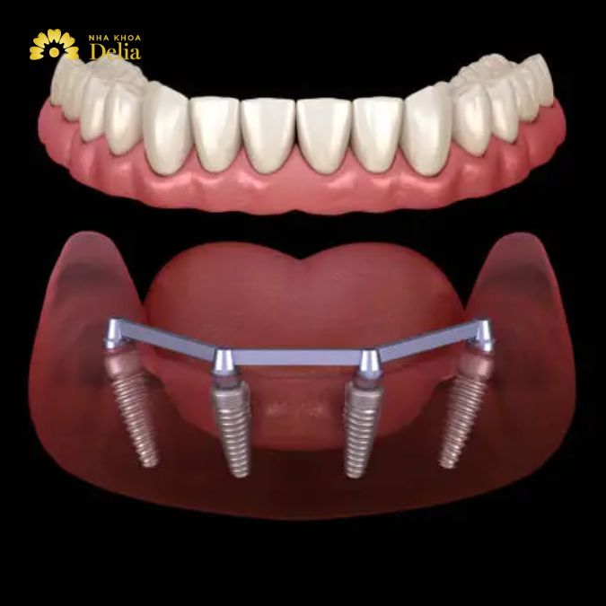 Cost Factors for All on 4 Implants