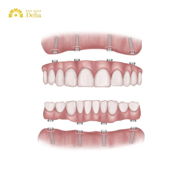 What are all-on-4 dental Implants?