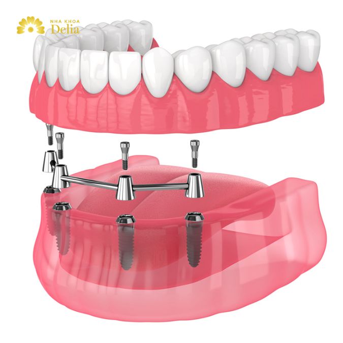 Common problems with all on 4 dental Implants