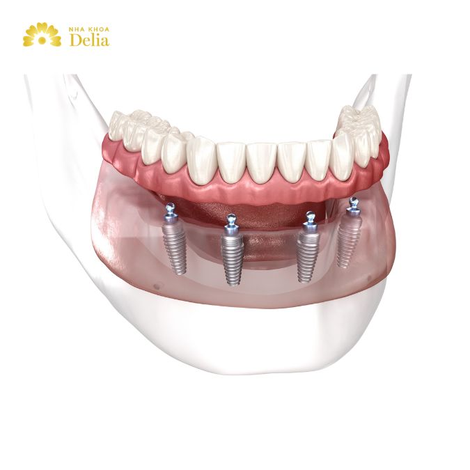 Common All on 4 dental implants problems and solutions