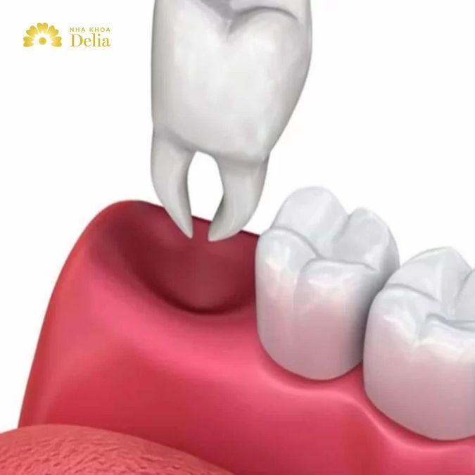 Cách vệ sinh lỗ răng khôn sau khi nhổ