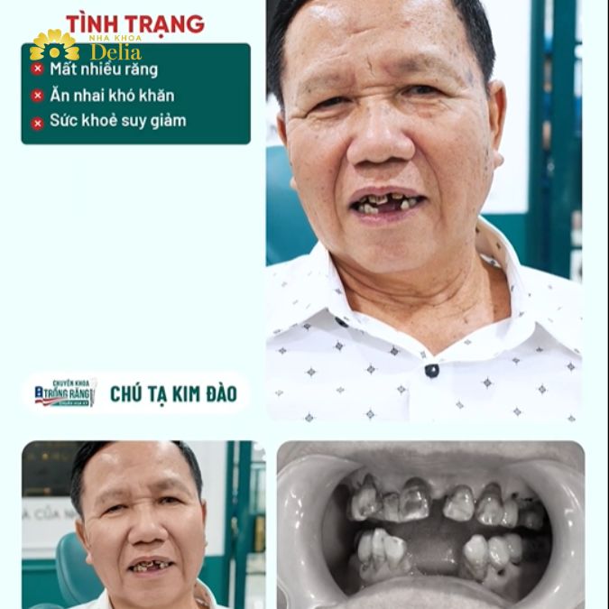 Tình trạng mất nhiều răng của ba diễn viên Anh Đức