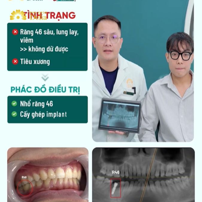 Tình trạng và phác đồ điều trị răng của bạn Long