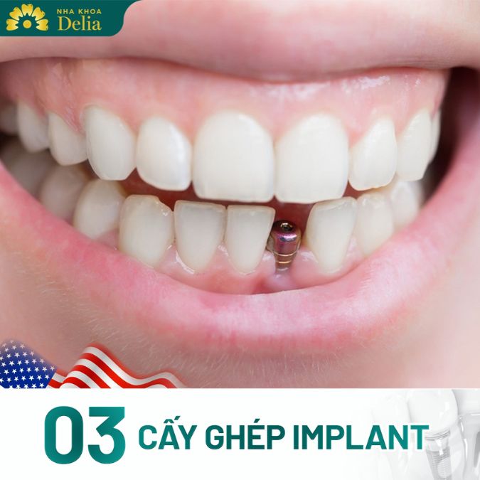 Phẫu thuật cấy ghép Implant