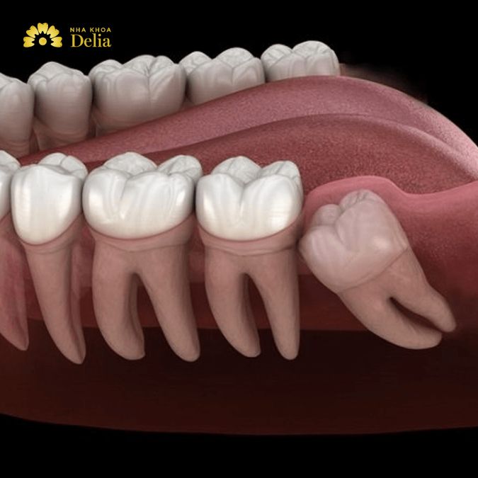 Có nên nhổ răng khôn khi đang bị đau?