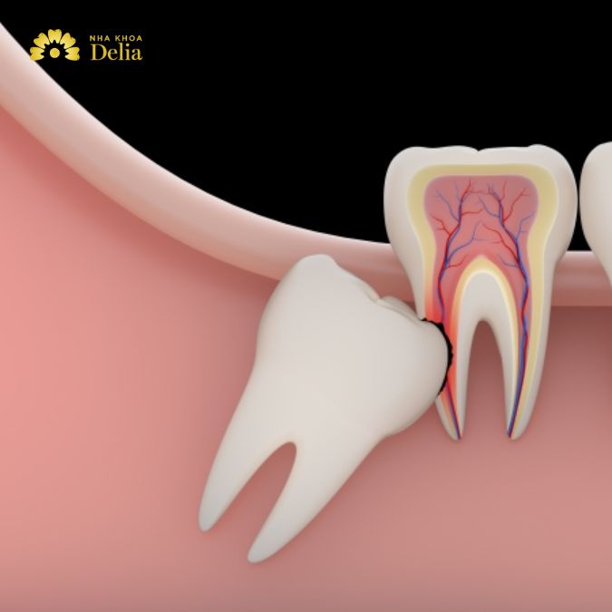 Có nên nhổ răng khôn khi đang bị đau không, ảnh hưởng gì không?