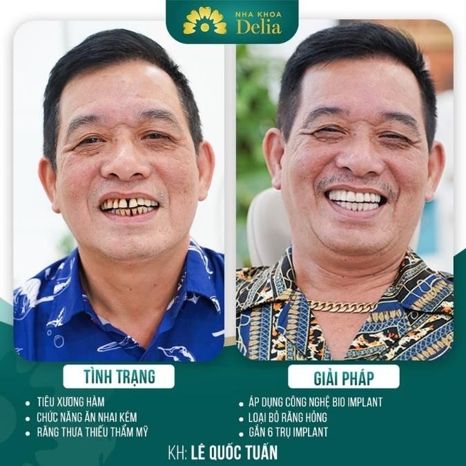 Sau khi trồng răng hàm tại Nha Khoa Delia, tôi cảm thấy rất hài lòng với kết quả