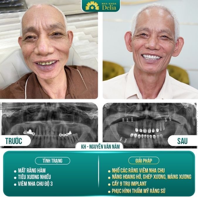 Quy trình được thực hiện một cách chính xác, và kết quả thật sự vượt ngoài mong đợi