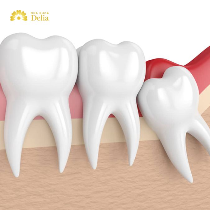 Răng khôn, hay còn được gọi là răng số 8, là những chiếc răng cối lớn cuối cùng trong hàm răng của con người.