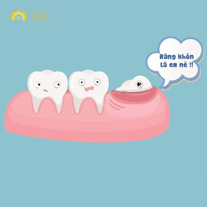 Mọc răng khôn thường gây đau đớn vì nhiều lý do