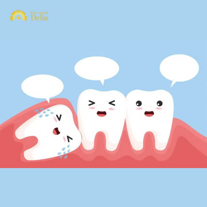 Răng khôn gây viêm nhiễm, sưng tấy và đau nhức