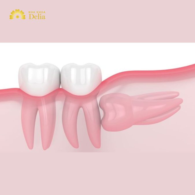 Răng khôn mọc ngầm cần làm gì để tránh biến chứng nguy hiểm?