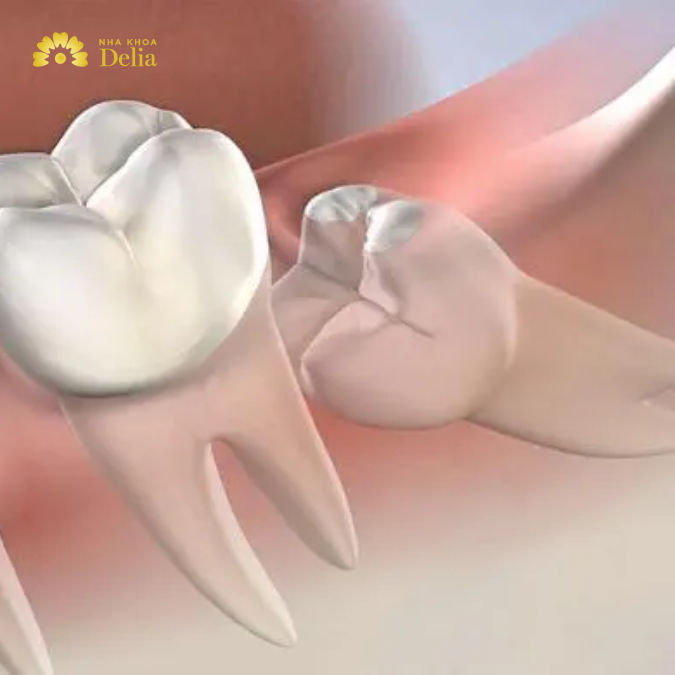 Răng khôn mọc ngang có ảnh hưởng gì không?