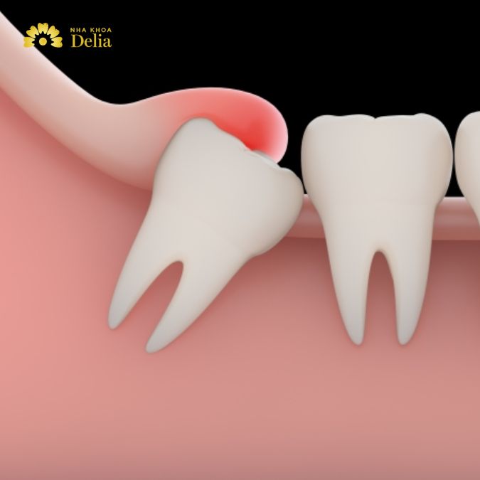Sưng nướu răng khôn là tình trạng viêm nhiễm xảy ra tại khu vực nướu quanh răng khôn