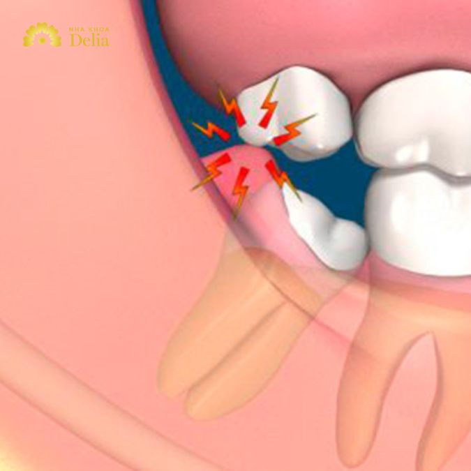 Phòng ngừa sưng nướu răng khôn cần kết kợp các biện pháp nha khoa và tại nhà