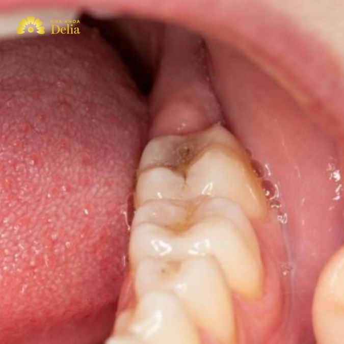 Sưng nướu răng khôn là như thế nào, điều trị ra sao?