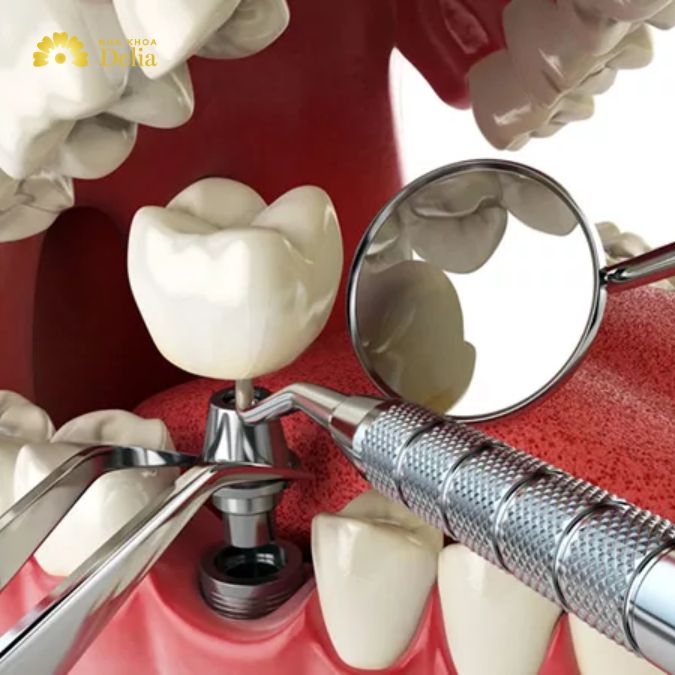 Trồng răng implant bây giờ có kịp ăn Tết