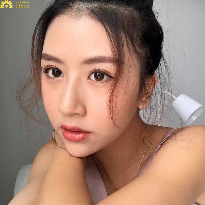 Khuôn mặt V line với đường viền hàm sắc nét, thon gọn