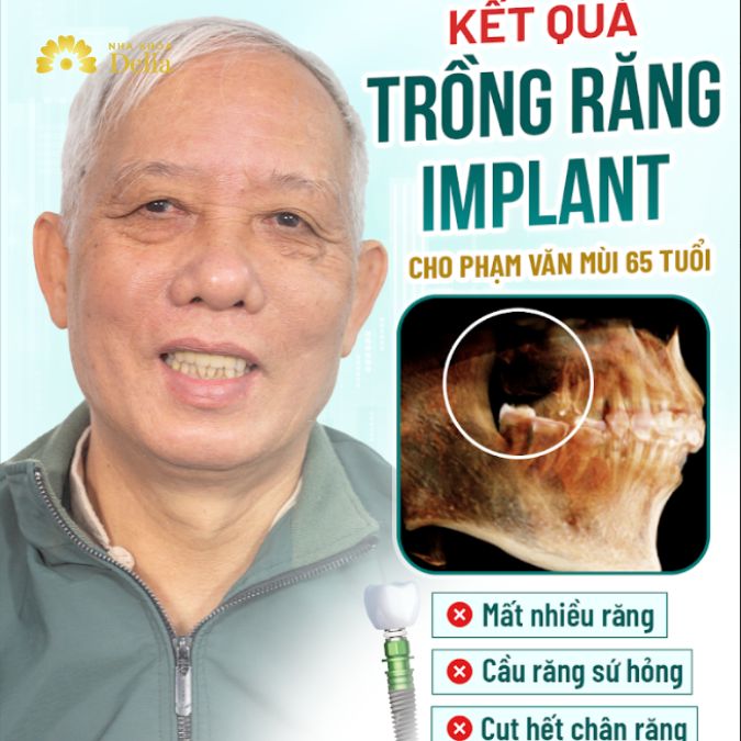 Niềm vui mới của chú Mùi nhờ trồng răng Implant tại Delia