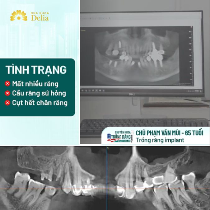 Tình trạng mất răng của chú Mùi khá nghiêm trọng
