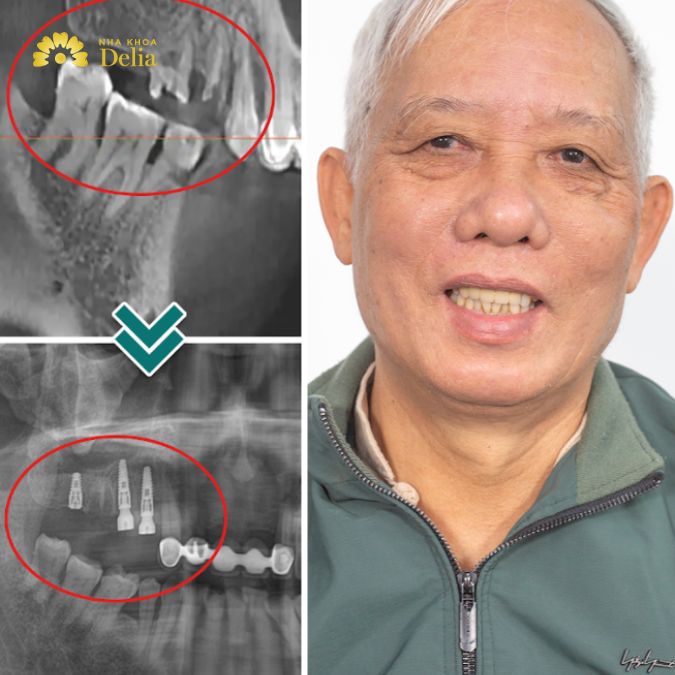 Bác sĩ lên phác đồ điều trị mất răng cho chú Mùi