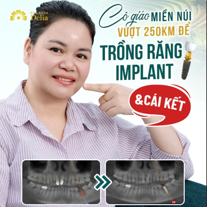 Cô giáo miền núi vượt 250km để trồng răng Implant và cái kết