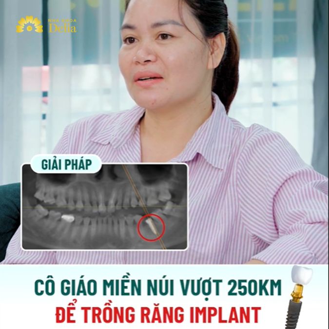 Bác sĩ lên phác đồ điều trị cắm trụ implant cho cô giáo trẻ