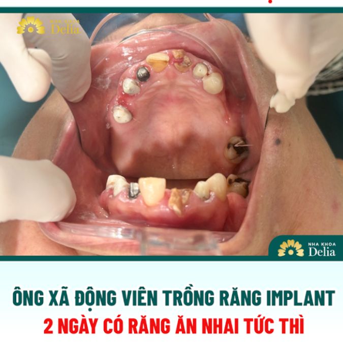 Tình trạng mất răng của cô Khiêm nhiều năm qua