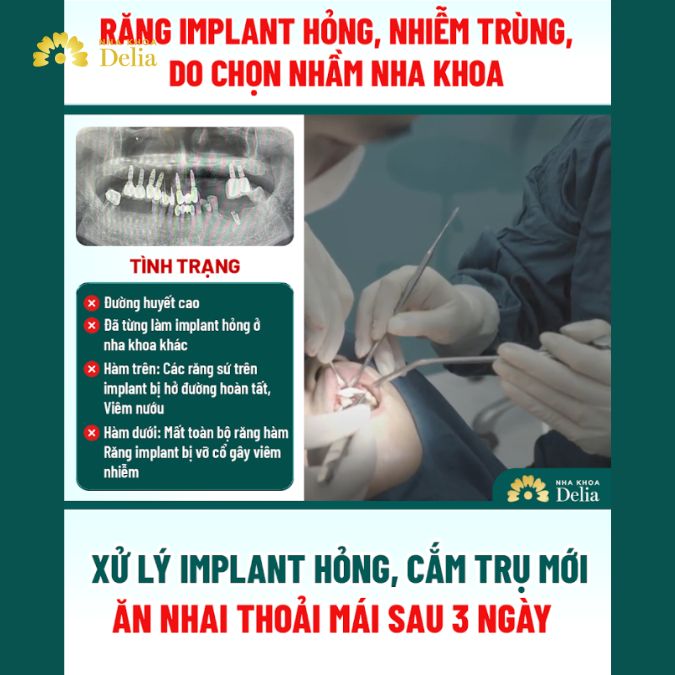 Tình trạng răng của chú Chiêu trước khi đến với Delia