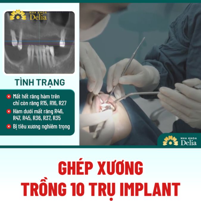 Tình trạng mất răng tổng quát của cô Nancy
