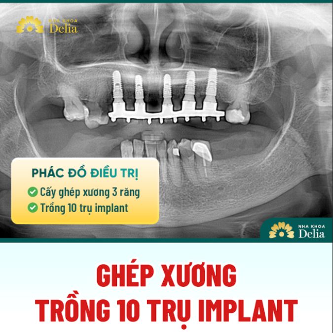 Phác đồ điều trị của cô Nancy tại nha khoa Delia