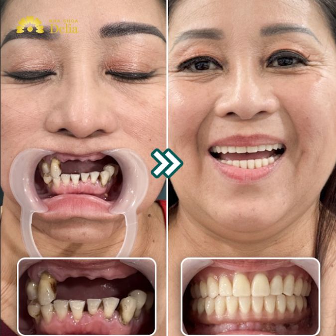 Hình ảnh răng chị Thảo trước và sau cấy Implant tại Delia