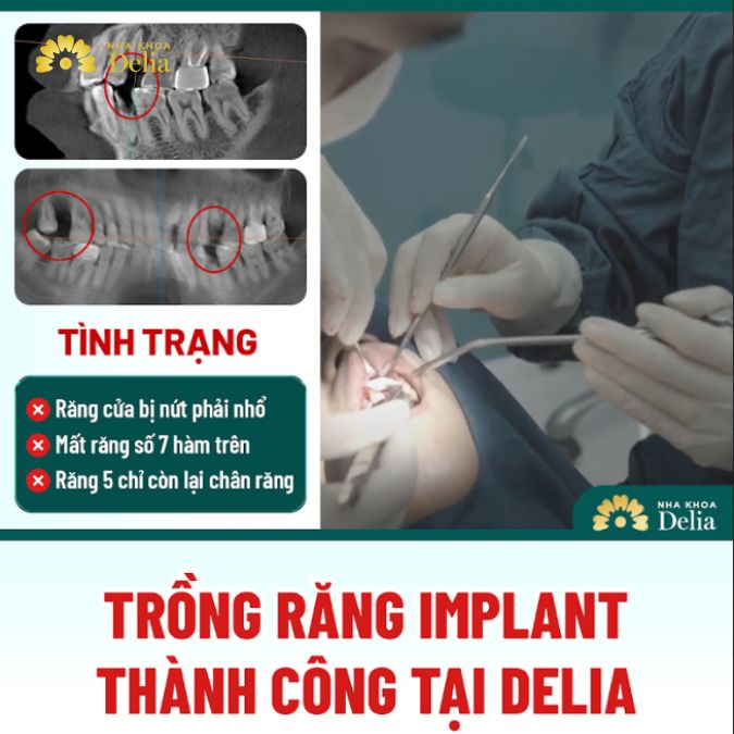 Tình trạng mất răng của chú Dũng trước khi đến với Delia