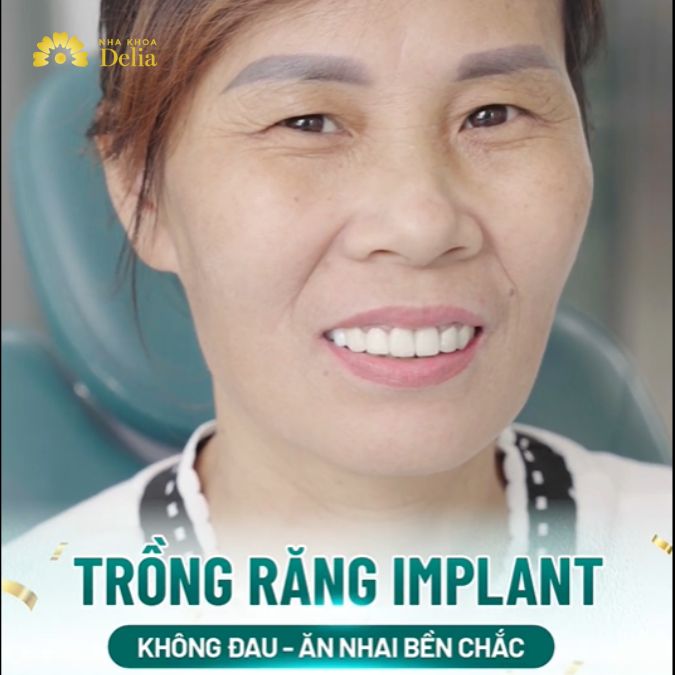 Chị Nguyệt tự tin với nụ cười mới sau trồng Implant