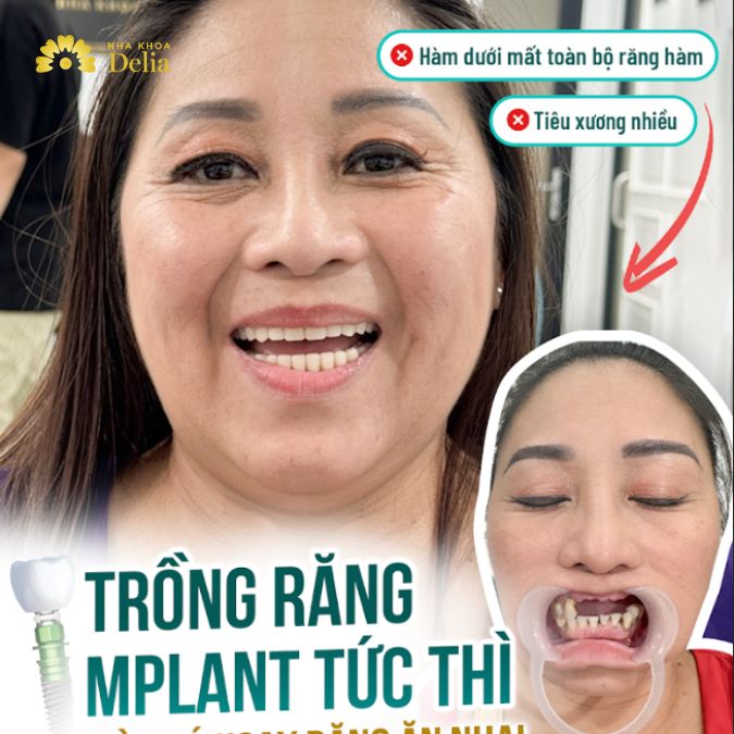 Trồng răng implant tức thì, 2 ngày có ngay răng ăn nhai - chị Dạ Thảo Việt Kiều Mỹ