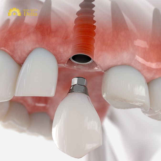 Immediate dental implants are a modern dental procedure designed for the rapid restoration of missing teeth.