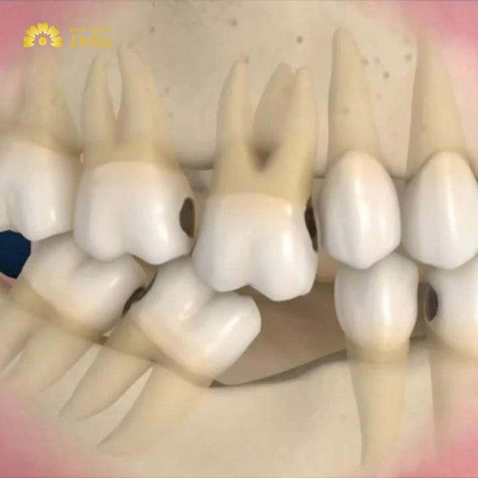 Sâu răng và bệnh nha chu là nguyên nhân hàng đầu gây mất răng nhai.