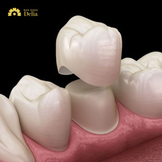 Bọc răng sứ là phương pháp phục hồi chức năng và thẩm mỹ cho những răng nhai còn lại bằng cách phủ lớp vỏ sứ bên ngoài.