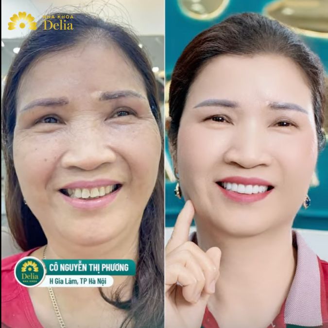 ành trình thẩm mỹ răng sứ Orodent Gold của cô Phương tại Delia 