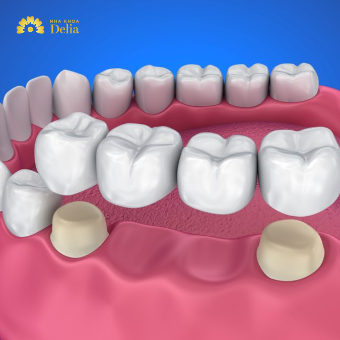 Cầu răng là phương pháp thay thế khi răng cấm bị bể không thể phục hồi bằng các phương pháp khác