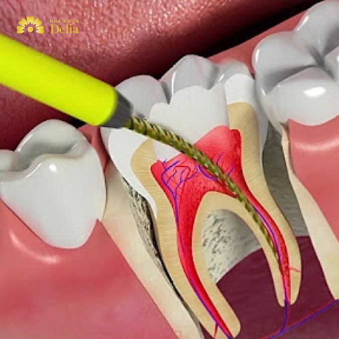 Khi sâu răng tiến triển mạnh và đã ảnh hưởng đến tủy cần lấy tủy răng để điều trị triệt để