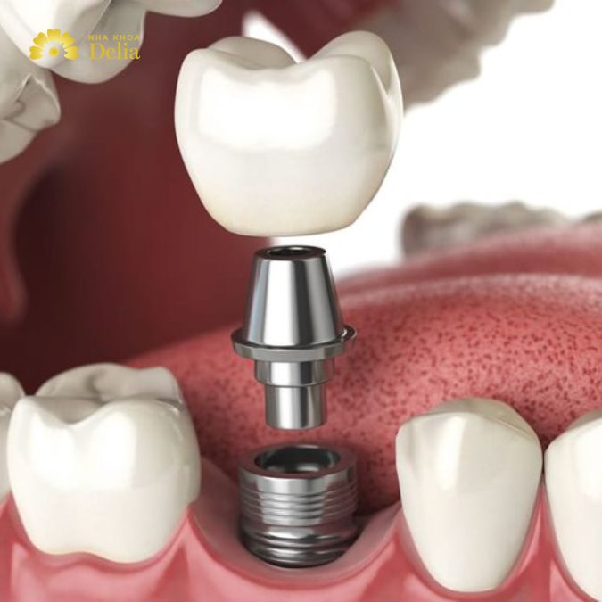 Cấy ghép răng implant là một trong những giải pháp thay thế răng mất hiệu quả nhất hiện nay