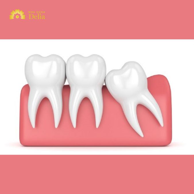 Răng cấm có thay không? Răng cấm trẻ em có thay không?