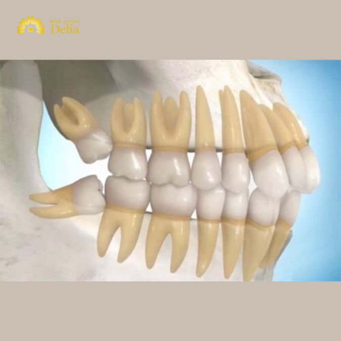 Răng cấm mọc lệch có sao không, cần phải làm gì?