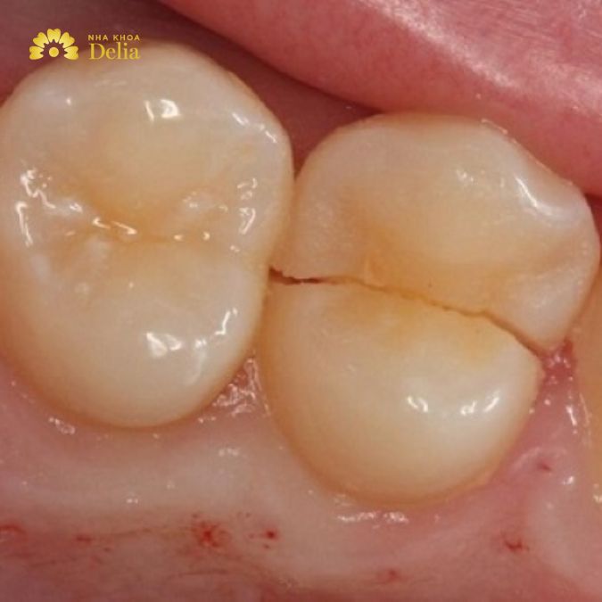 Tác động của việc nghiến răng vào ban đêm khiến răng nhai bị bể