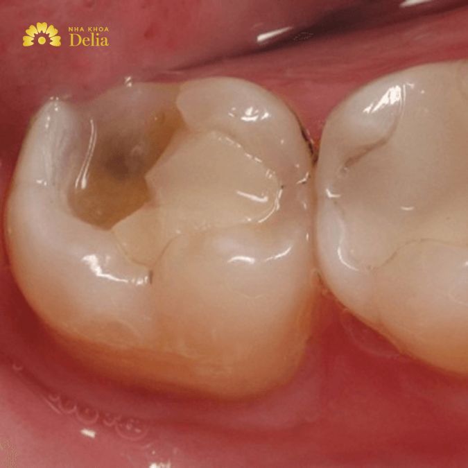 Răng nhai bị bể có nghiêm trọng không, cần làm gì?