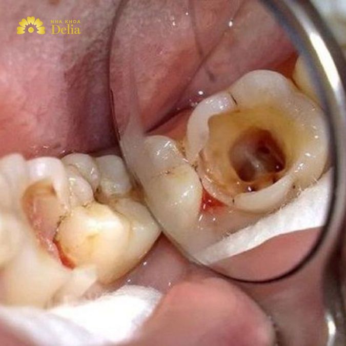 Sâu răng là một trong những nguyên nhân phổ biến nhất gây ra đau ở răng nhai