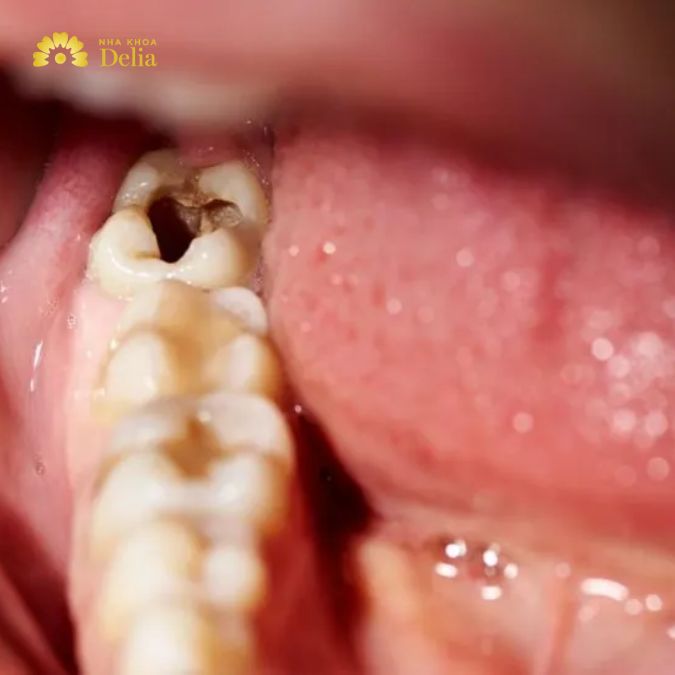 Khi tuổi tác tăng lên, men răng có xu hướng mỏng dần và các khe răng có thể trở nên sâu hơn, tạo điều kiện thuận lợi cho vi khuẩn xâm nhập và gây sâu răng.