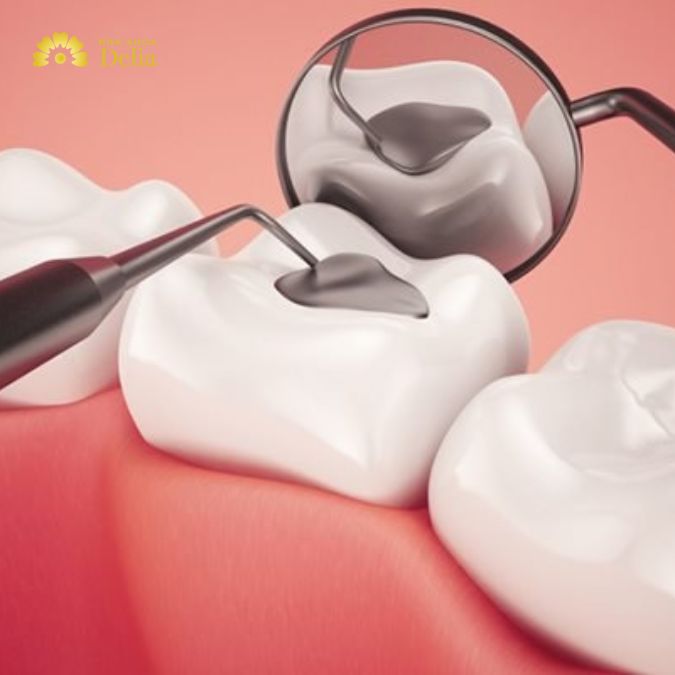 Hàn trám răng là một phương pháp phổ biến trong điều trị sâu răng